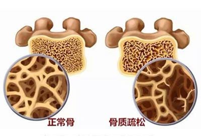 便攜式骨密度檢測(cè)儀品牌介紹骨密度高了低了都不好人體峰值骨量多少歲蕞佳？