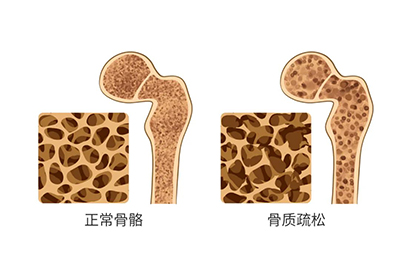 骨密度儀品牌：“何不食肉糜”張專家再談四小時睡眠，保障睡眠增加骨密度