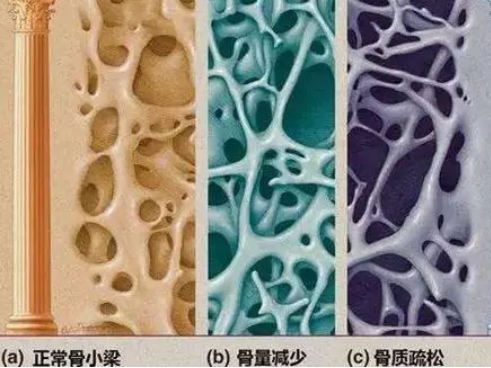 河北承德GK-7000骨密度檢測儀廠家：骨質疏松要少吃哪些食物