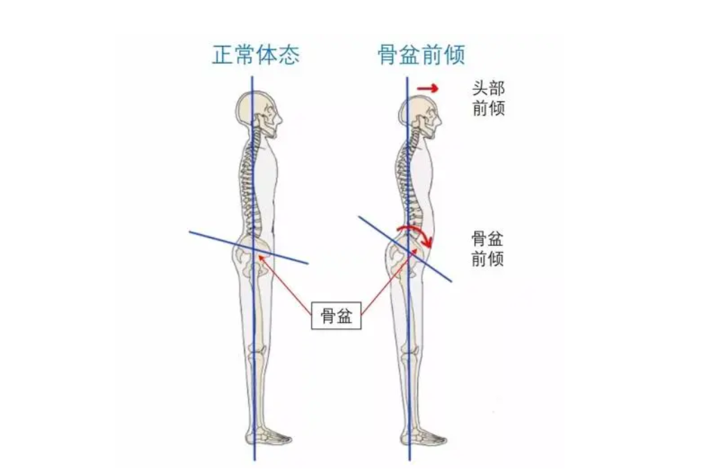 7.5國康資訊：超聲骨密度分析儀廠家介紹什么事骨盆前傾，發(fā)生的原因是什么?